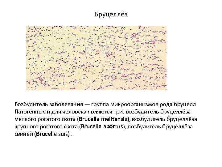 Бруцеллёз Возбудитель заболевания — группа микроорганизмов рода бруцелл. Патогенными для человека являются три: возбудитель