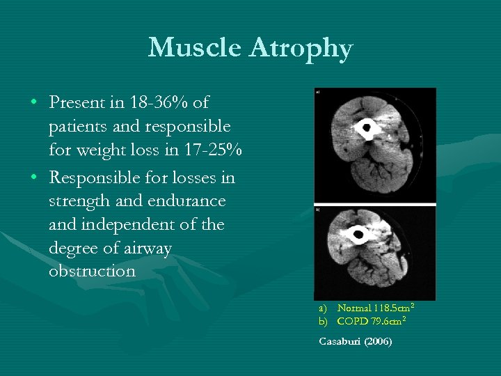 Muscle Atrophy • Present in 18 -36% of patients and responsible for weight loss