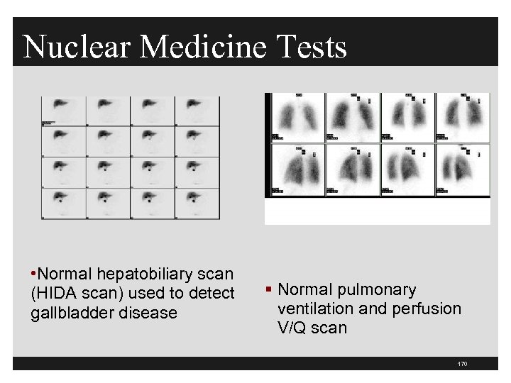 Nuclear Medicine Tests • Normal hepatobiliary scan (HIDA scan) used to detect gallbladder disease