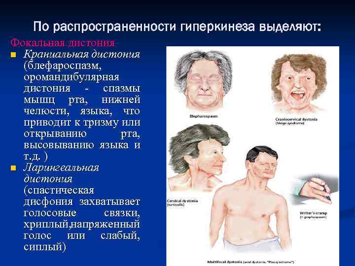 По распространенности гиперкинеза выделяют: Фокальная дистония n Краниальная дистония (блефароспазм, оромандибулярная дистония - спазмы