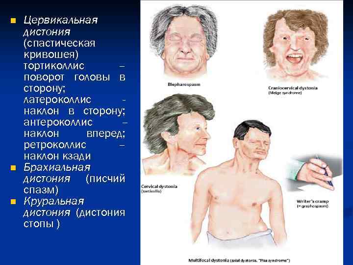 n n n Цервикальная дистония (спастическая кривошея) тортиколлис – поворот головы в сторону; латероколлис