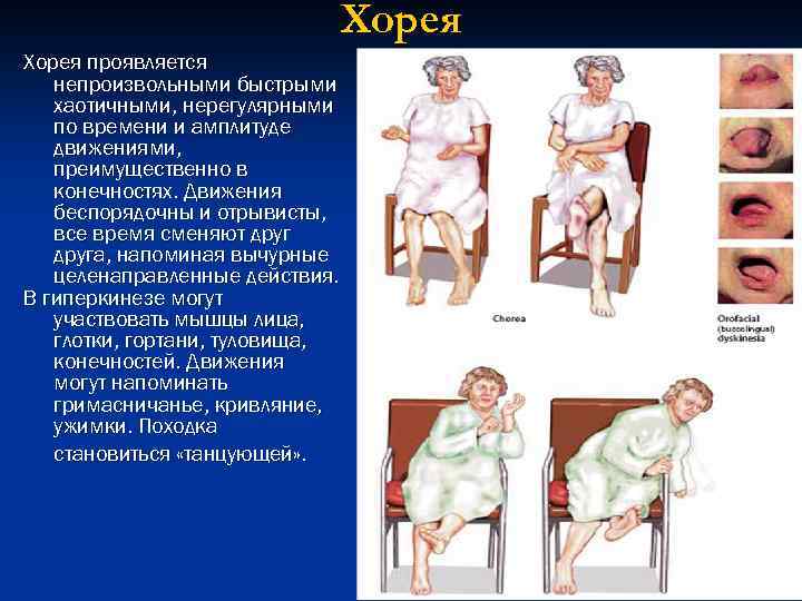 Хорея проявляется непроизвольными быстрыми хаотичными, нерегулярными по времени и амплитуде движениями, преимущественно в конечностях.