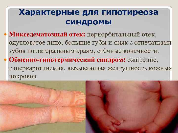 Характерные для гипотиреоза синдромы Микседематозный отек: периорбитальный отек, одутловатое лицо, большие губы и язык