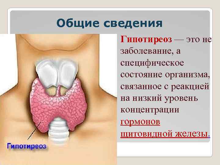 Общие сведения Гипотиреоз — это не заболевание, а специфическое состояние организма, связанное с реакцией