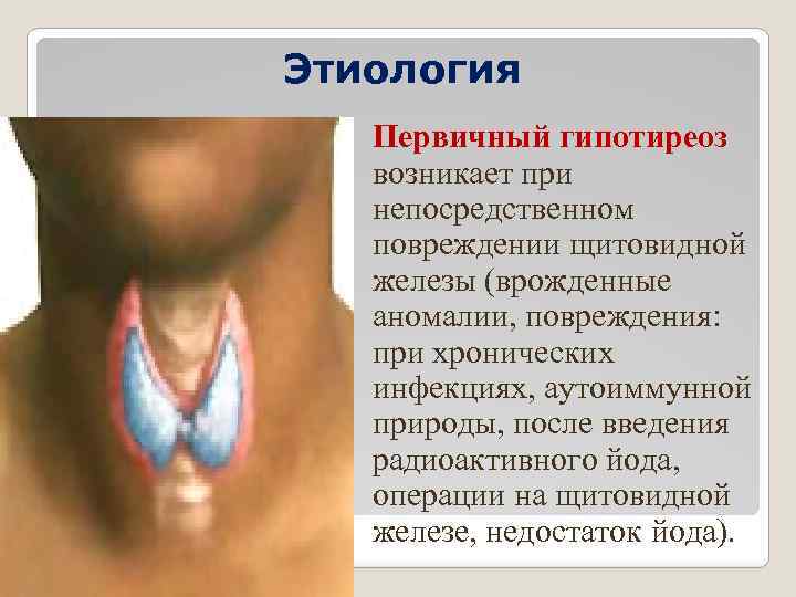 Этиология Первичный гипотиреоз возникает при непосредственном повреждении щитовидной железы (врожденные аномалии, повреждения: при хронических