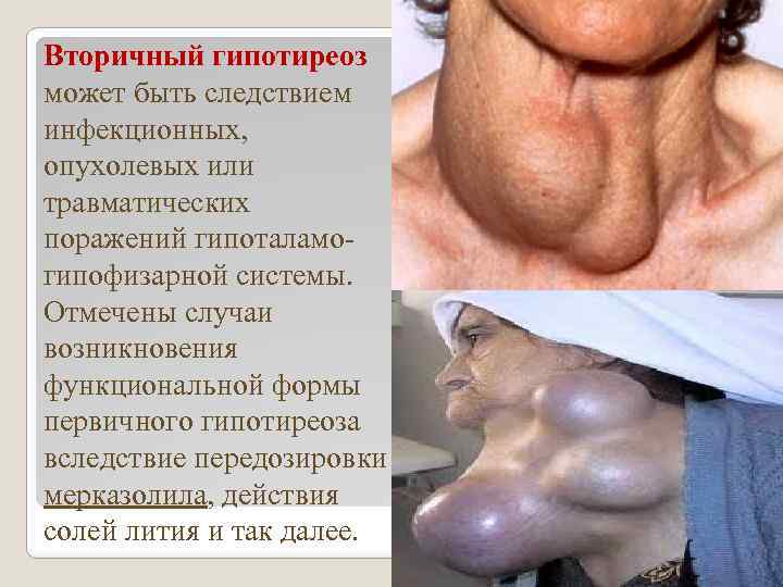 Вторичный гипотиреоз может быть следствием инфекционных, опухолевых или травматических поражений гипоталамогипофизарной системы. Отмечены случаи