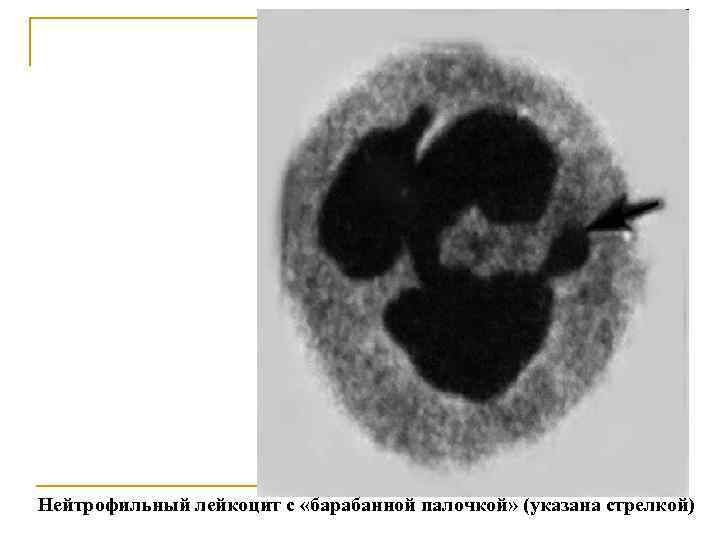  Нейтрофильный лейкоцит с «барабанной палочкой» (указана стрелкой) 