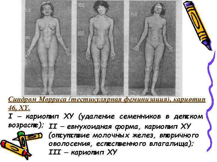  Синдром Морриса (тестикулярная феминизация), кариотип 46, XY. I кариотип XY (удаление семенников в