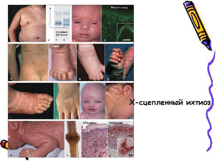 Х-сцепленный ихтиоз 