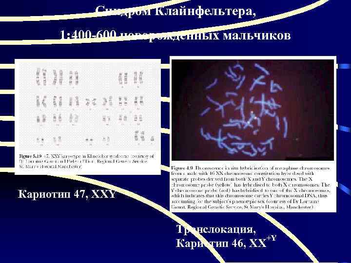 Синдром Клайнфельтера, 1: 400 -600 новорожденных мальчиков Кариотип 47, ХХY Транслокация, +Y Кариотип 46,