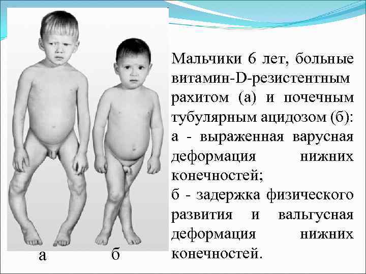 а б Мальчики 6 лет, больные витамин-D-резистентным рахитом (а) и почечным тубулярным ацидозом (б):