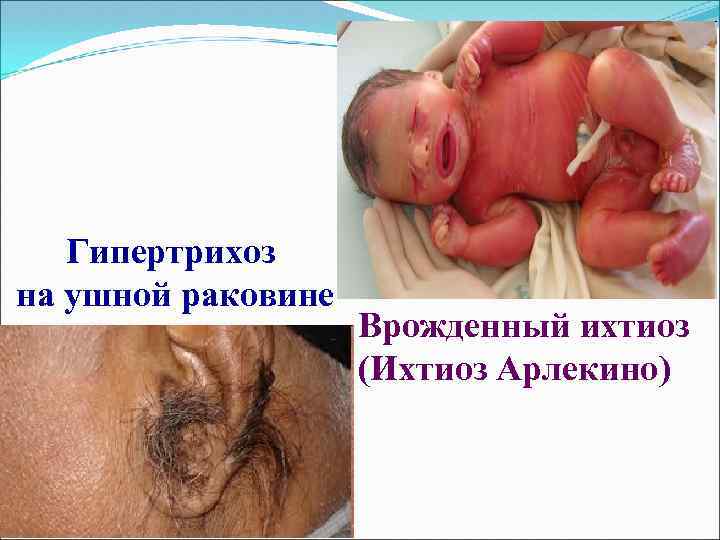 Гипертрихоз на ушной раковине Врожденный ихтиоз (Ихтиоз Арлекино) 