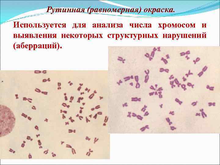 Рутинная (равномерная) окраска. Используется для анализа числа хромосом и выявления некоторых структурных нарушений (аберраций).