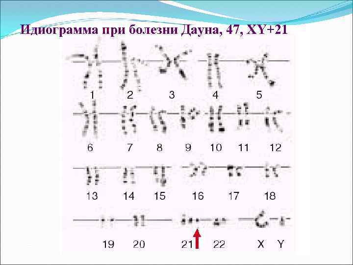 Идиограмма при болезни Дауна, 47, ХY+21 