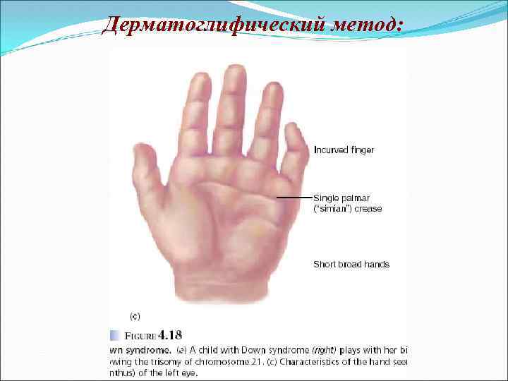 Дерматоглифический метод: 