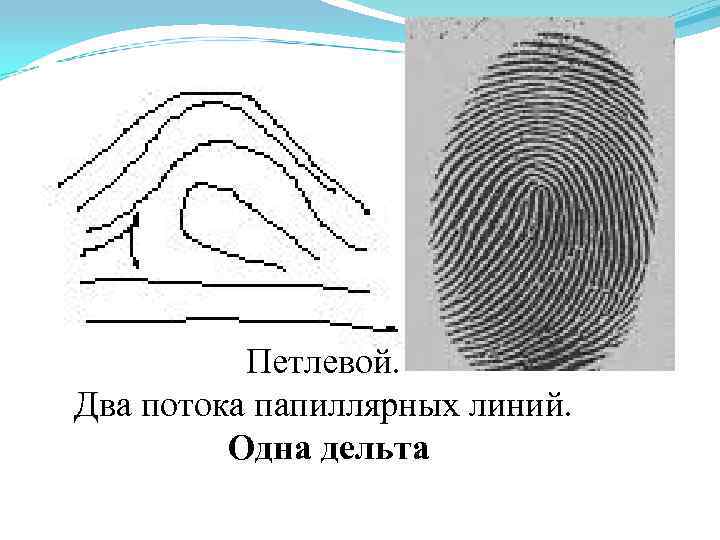 Петлевой. Два потока папиллярных линий. Одна дельта 