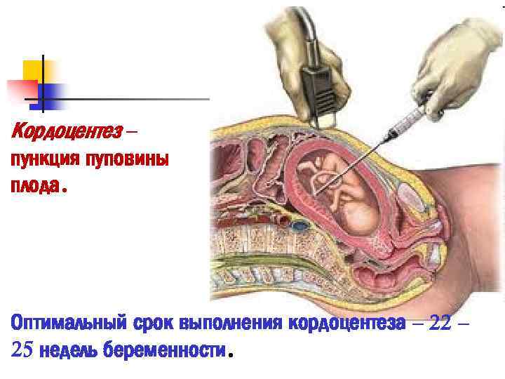 Кордоцентез – пункция пуповины плода. Оптимальный срок выполнения кордоцентеза – 22 – 25 недель