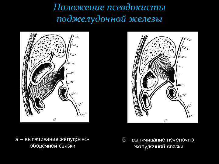 Псевдокиста поджелудочной железы. Псевдокисты поджелудочной железы. Хирургическое лечение псевдокист поджелудочной железы. Псевдокисты поджелудочной железы лечение. Внутреннее дренирование псевдокисты.