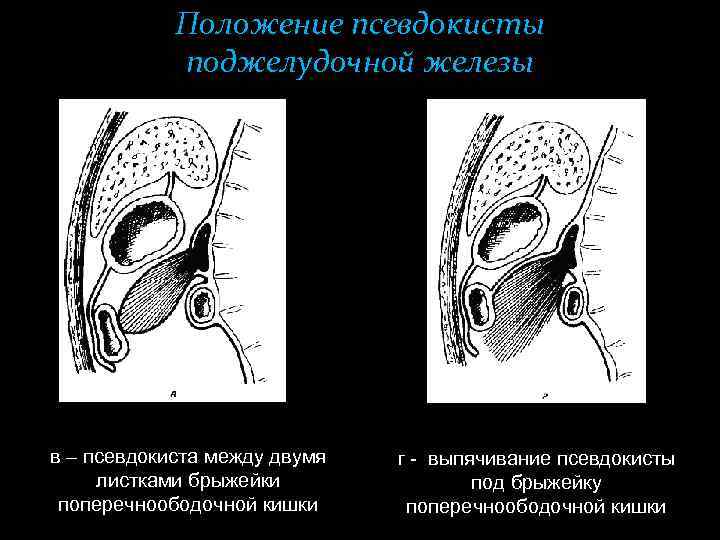 Псевдокиста поджелудочной железы