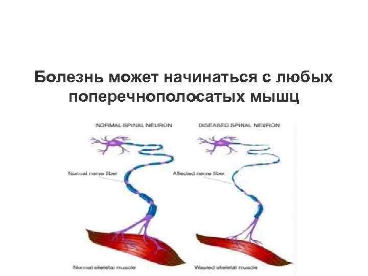 Болезнь может начинаться с любых поперечнополосатых мышц 