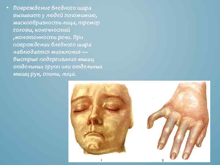  • Повреждение бледного шара вызывает у людей гипомимию, маскообразность лица, тремор головы, конечностей