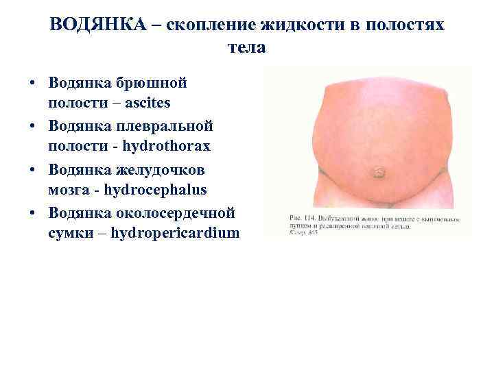 ВОДЯНКА – скопление жидкости в полостях тела • Водянка брюшной полости – ascites •