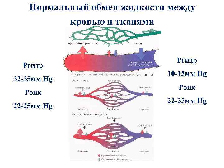 Нормальный обмен жидкости между кровью и тканями Ргидр 32 -35 мм Hg Ронк 22