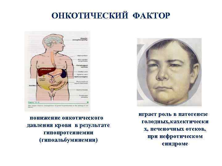 ОНКОТИЧЕСКИЙ ФАКТОР понижение онкотического давления крови в результате гипопротеинемии (гипоальбуминемии) играет роль в патогенезе