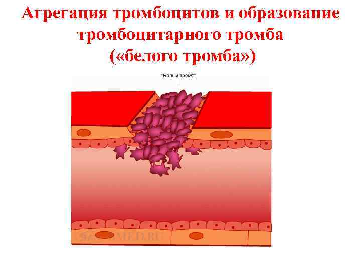 Агрегация тромбоцитов и образование тромбоцитарного тромба ( «белого тромба» ) 