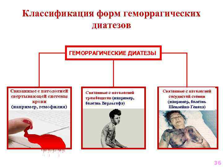 Классификация форм геморрагических диатезов ГЕМОРРАГИЧЕСКИЕ ДИАТЕЗЫ Связанные с патологией свертывающей системы крови (например, гемофилия)