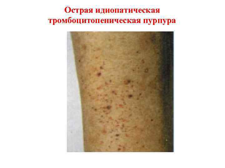 Острая идиопатическая тромбоцитопеническая пурпура 