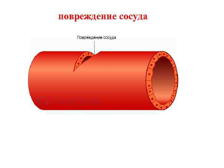 повреждение сосуда 