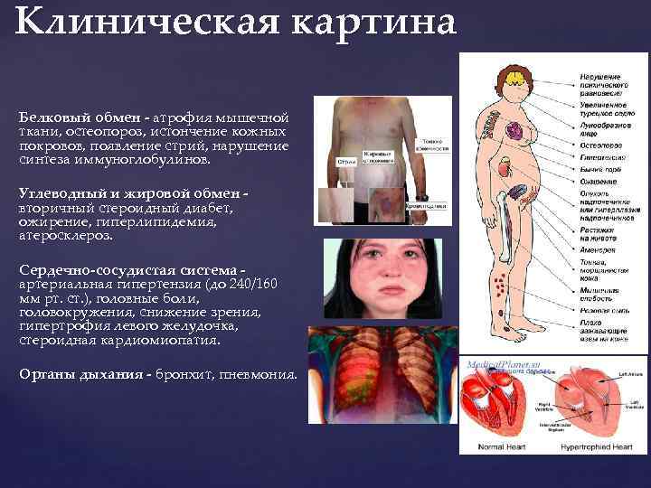Клиническая картина Белковый обмен - атрофия мышечной ткани, остеопороз, истончение кожных покровов, появление стрий,