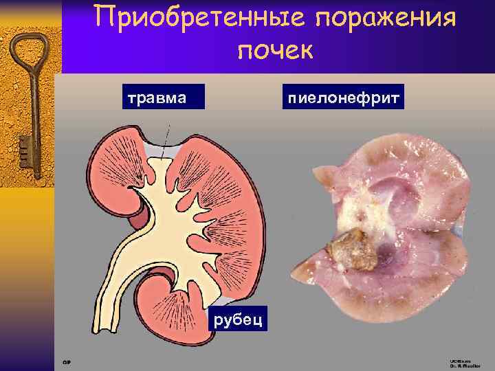 Приобретенные поражения почек травма пиелонефрит рубец 