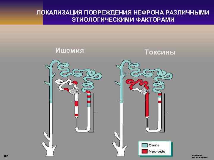 ЛОКАЛИЗАЦИЯ ПОВРЕЖДЕНИЯ НЕФРОНА РАЗЛИЧНЫМИ ЭТИОЛОГИЧЕСКИМИ ФАКТОРАМИ Ишемия Токсины 