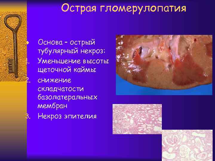 Острая гломерулопатия Основа – острый тубулярный некроз: 1. Уменьшение высоты щеточной каймы 2. снижение