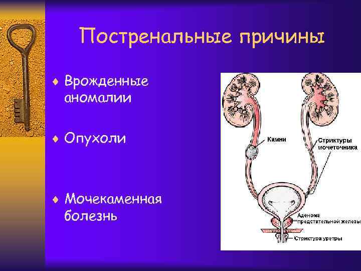 Постренальные причины ¨ Врожденные аномалии ¨ Опухоли ¨ Мочекаменная болезнь 