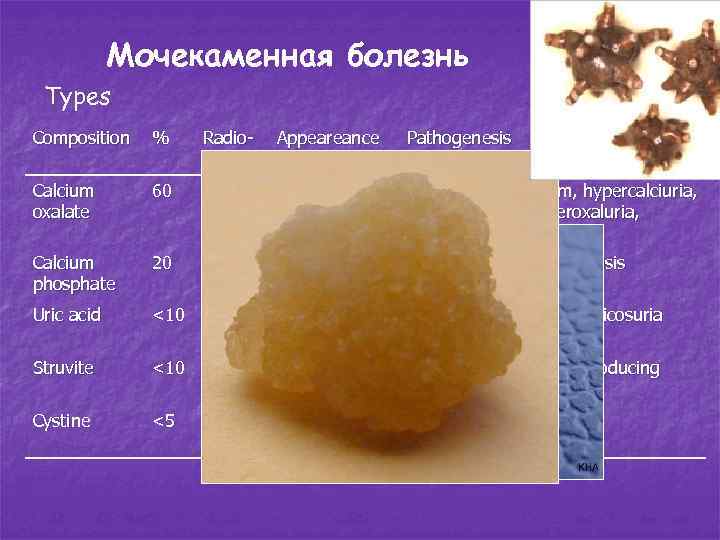 Мочекаменная болезнь Types Composition % Radio- Appeareance opaque Calcium oxalate 60 +++ Small, smooth