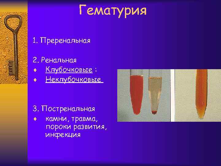 Гематурия 1. Преренальная 2. Ренальная ¨ Клубочковые : ¨ Неклубочковые 3. Постренальная ¨ камни,