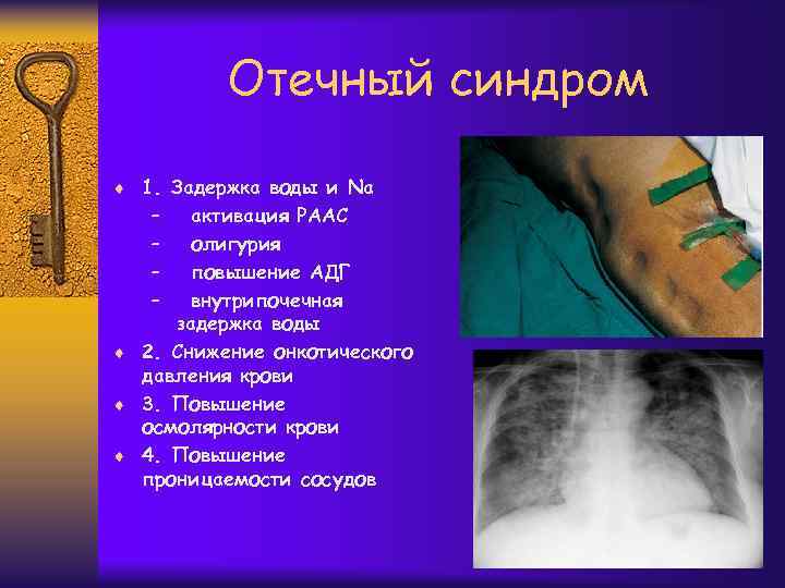 Отечный синдром ¨ 1. Задержка воды и Na – – активация РААС олигурия повышение