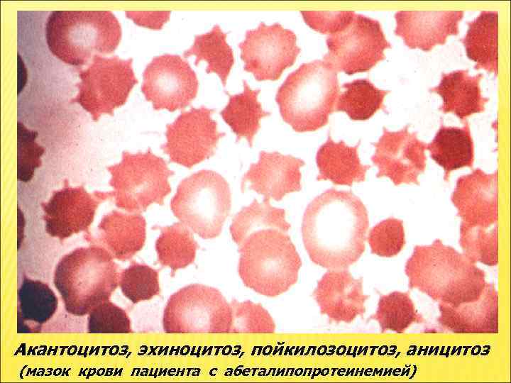 Акантоцитоз, эхиноцитоз, пойкилозоцитоз, аницитоз (мазок крови пациента с абеталипопротеинемией) 