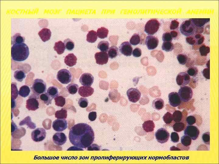 КОСТНЫЙ МОЗГ ПАЦИЕТА ПРИ ГЕМОЛИТИЧЕСКОЙ АНЕМИИ Большое число зон пролиферирующих нормобластов 