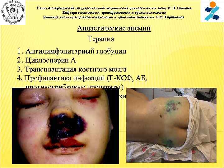 Санкт-Петербургский государственный медицинский университет им. акад. И. П. Павлова Кафедра гематологии, трансфузиологии и трансплантологии