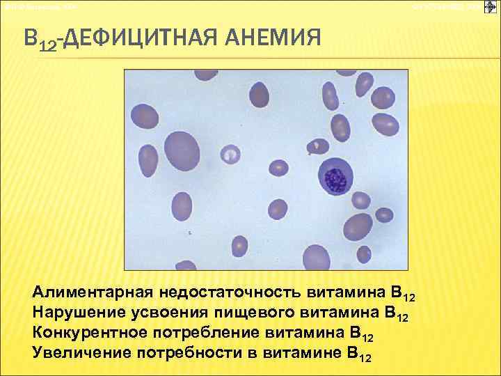 © П. Ф. Литвицкий, 2004 © ГЭОТАР-МЕД, 2004 В 12 -ДЕФИЦИТНАЯ АНЕМИЯ Алиментарная недостаточность