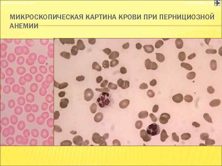 © П. Ф. Литвицкий, 2004 © ГЭОТАР-МЕД, 2004 МИКРОСКОПИЧЕСКАЯ КАРТИНА КРОВИ ПРИ ПЕРНИЦИОЗНОЙ АНЕМИИ