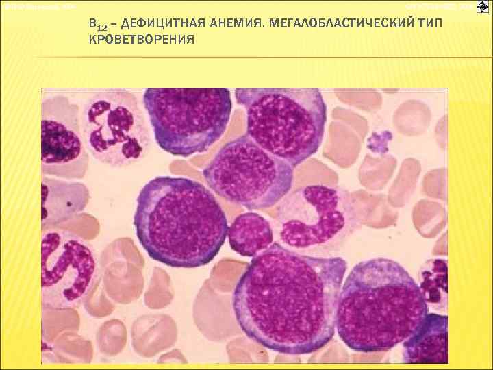 © П. Ф. Литвицкий, 2004 © ГЭОТАР-МЕД, 2004 В 12 – ДЕФИЦИТНАЯ АНЕМИЯ. МЕГАЛОБЛАСТИЧЕСКИЙ