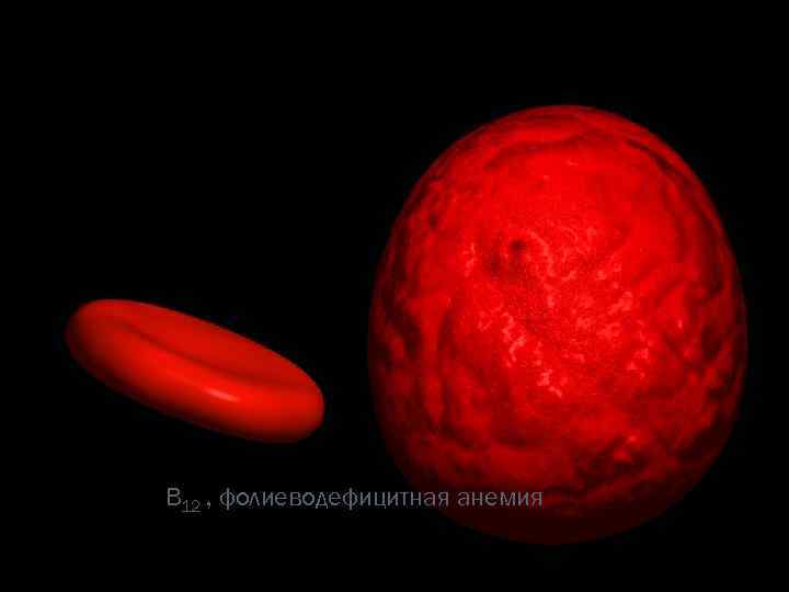 © П. Ф. Литвицкий, 2004 © ГЭОТАР-МЕД, 2004 МЕГАЛОЦИТЫ B 12 , фолиеводефицитная анемия