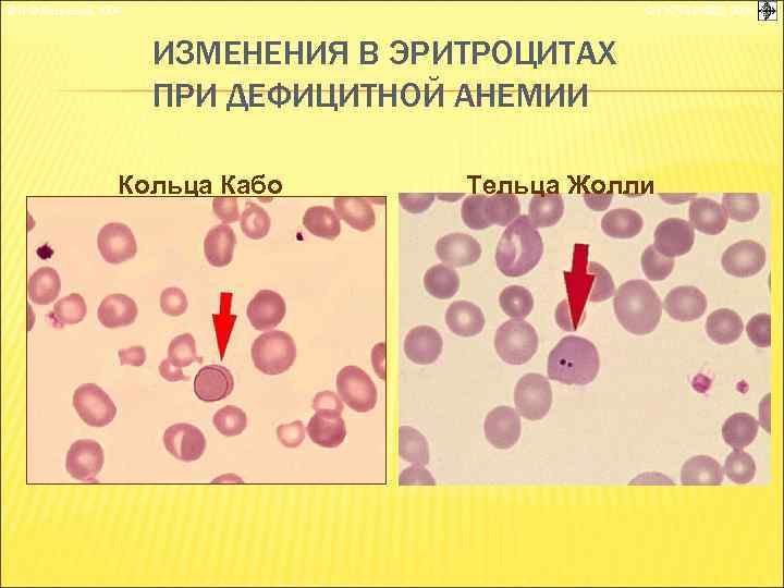 © П. Ф. Литвицкий, 2004 © ГЭОТАР-МЕД, 2004 ИЗМЕНЕНИЯ В ЭРИТРОЦИТАХ ПРИ ДЕФИЦИТНОЙ АНЕМИИ