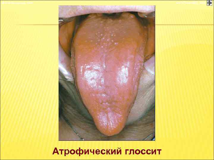 © П. Ф. Литвицкий, 2004 © ГЭОТАР-МЕД, 2004 Атрофический глоссит 