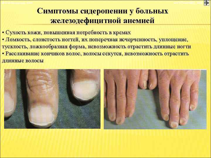 © П. Ф. Литвицкий, 2004 © ГЭОТАР-МЕД, 2004 Симптомы сидеропении у больных железодефицитной анемией